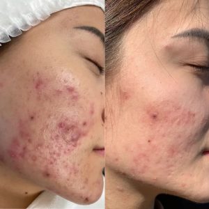 How to Heal and Prevent Breakouts Naturally and Effectively
