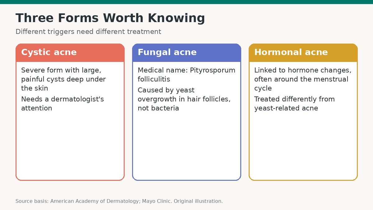 Types of Acne: How to Tell a Whitehead From a Cyst